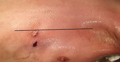 Se observa el sitio de la incisión en la línea axilar posterior; justo antes de realizarla se recomienda reforzar la dosis de relajación muscular.