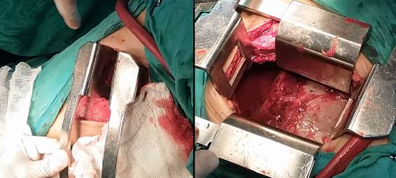 Secuencia de la colocación de los separadores, período en que la relajación muscular debe ser óptima