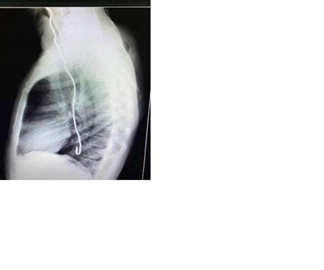 Radiografía de tórax que muestra el cuerpo extraño en el esófago torácico
