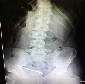 Radiografía de abdomen simple de pie mostrando un cuerpo extraño en la pelvis del paciente
