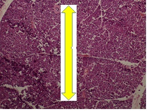 Tejido pancre&aacute;tico normal y patol&oacute;gico del paciente.