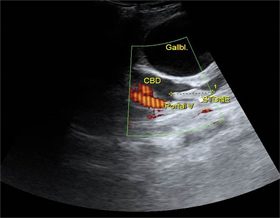 Ecograf&iacute;a de abdomen (vista longitudinal a nivel del col&eacute;doco) que muestra un c&aacute;lculo alargado dentro del col&eacute;doco dilatado y con flujo en la vena porta despu&eacute;s de la aplicaci&oacute;n del Doppler A.
