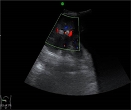 La vista axial a nivel de las v&iacute;as biliares intrahep&aacute;ticas muestra hiperecogenicidad (litiasis) dentro de los conductos biliares intrahep&aacute;ticos dilatados. (B).