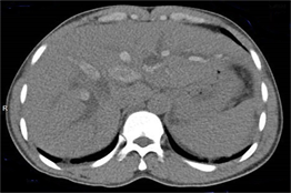 Tomograf&iacute;a axial computarizada de abdomen, vista axial a nivel hep&aacute;tico sin contraste
