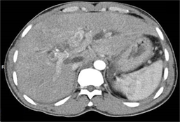 Tomograf&iacute;a axial y con contraste en la fase arterial, muestra hiperdensidad (densidad de calcio) en la v&iacute;a biliar dilatada por presencia de litiasis en las v&iacute;as biliares.