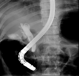 La colangiopancreatografia endosc&oacute;pica retr&oacute;grada muestra un gran defecto de llenados lineales y m&uacute;ltiples peque&ntilde;os defectos de llenado.