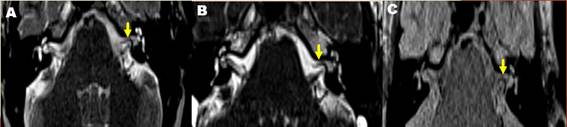 Imagen de resonancia magn&eacute;tica nuclear, en secuencia de T2 ciss3D axial (A y B). C, T2 TSE AXIAL. Se observa bucle vascular (flecha amarilla) producido por un trayecto redundante de la arteria cerebelosa anteroinferior (AICA) en el interior del conducto auditivo interno del lado izquierdo.