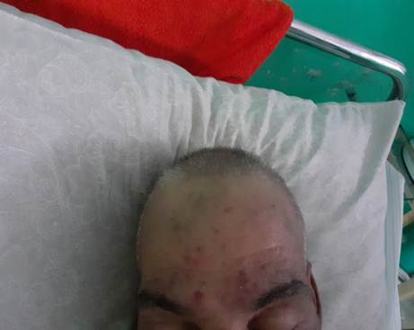 Imagen que muestra el eritema en heliotropo y edema en párpados.