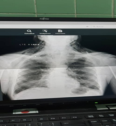 Imagen radiográfica que muestra enfisema celular subcutáneo e imagen sugerente de neumomediastino.