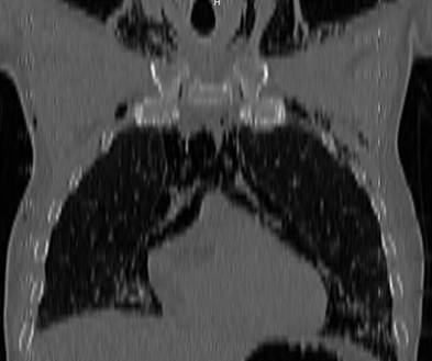 Imagen tomográfica que muestra presencia de aire en todos los compartimientos del mediastino, enfisema subcutáneo en las paredes anterior, posterior y laterales del tórax.