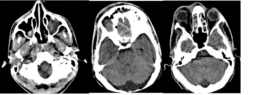De izquierda a derecha: 1) Seno maxilar izquierdo completamente ocupado por material hiperdenso, de aspecto inflamatorio; seno maxilar derecho con nivel. 2) Senos frontales parcialmente ocupados con igual material y presencia de varios niveles; megacisterna magna; 3)Celdillas etmoidales bilaterales ocupadas.