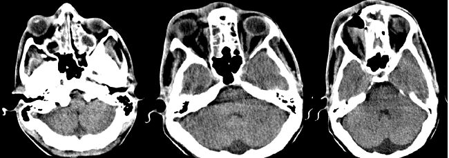 1) De izquierda a derecha: Proptosis, presencia de material hiperdenso, de aspecto inflamatorio, celdillas etmoidales y senos maxilares bilaterales. 2) Edema periorbitario derecho, colecci&oacute;n subperi&oacute;stica en la pared interna de la &oacute;rbita, con nivel, enfisema periorbitario derecho y perinasal. 3) Se evidencia mejor el nivel y colecci&oacute;n.