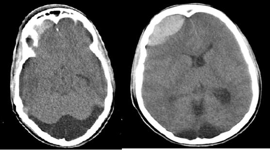 Imagen izquierda: Colecci&oacute;n hipodensa, en la porci&oacute;n postero inferior de la fosa craneal posterior que se corresponde con megacisterna magna; acentuaci&oacute;n del asta temporal del ventr&iacute;culo lateral izquierdo y ligero borramiento de surcos y circunvoluciones por HTE. Imagen derecha: colecci&oacute;n hiperdensa frontal anterosuperior, convexa hacia el par&eacute;nquima cerebral, en relaci&oacute;n con colecci&oacute;n epidural, con efecto de masa.