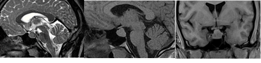Se observa la imagen hiperintensa a nivel de hipófisis.