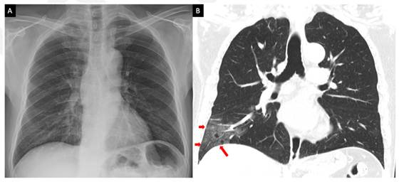 Ejemplo de imagen de CXR (A) e imagen de TC (B) de un paciente con COVID-19 positivo. Las flechas rojas muestran una lesión visible en la TC, pero no detectable mediante la CXR.