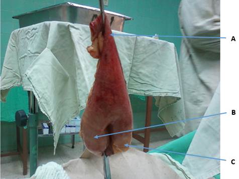 Divertículo de Meckel con segmento de intestino delgado adyacente. A: extremo proximal de intestino delgado resecado; B: divertículo de Meckel; C: extremo distal de intestino delgado resecado.