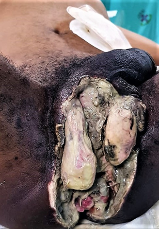 Paciente con gangrena de Fournier a punto de partida de absceso perianal y extensión a escroto. Presenta áreas de tejido necrótico y abundante esfacelo. Obsérvese la colostomía sigmoidea.