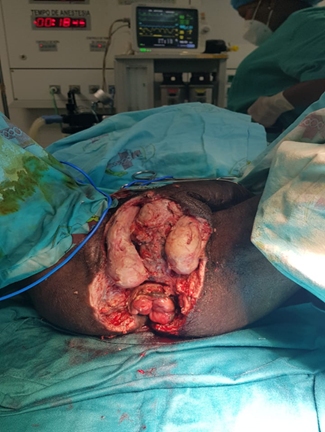 Paciente con gangrena de Fournier (el mismo de la figura 2) después de su tercera visita al salón de operaciones, prácticamente sin esfacelos ni focos de necrosis.