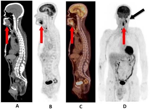 F18-FDG PET/CT convencional. A. Imagen CT sagital aparentemente normal. B. Imagen PET sagital mostrando acúmulo intenso y patológico del radiofármaco en raíz de la lengua con un SUVmax de 10.5 (flecha roja) C. Imagen fusionada PET y CT que reafirma el diagnóstico de la imagen PET (flecha roja) D. Imagen de máxima proyección (MIP, por sus siglas en inglés) muestra captación de nódulo linfático cervical derecho metastásico por el cual se llegó al diagnóstico (flecha negra) y el acúmulo en base de lengua en relación con tumor primario (flecha roja). Fuente: Foto del autor
