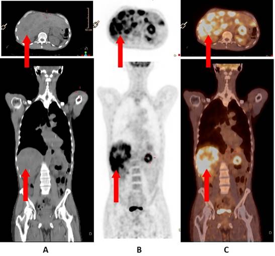 F18-FDG PET/CT convencional. A. Imagen CT axial y coronal con múltiples metástasis hepáticas sin posible primario. B. Imagen PET axial y coronal mostrando múltiples focos de hipercaptación en glándula hepática de aspecto metastásico con un SUVmax de 9,5, con foco hipermetabólico que toma cuerpo y cola del páncreas con un SUVmax de 6,5 como posible primario (flecha roja). C. Imagen fusionada PET/CT axial y coronal que reafirma el diagnóstico de la imagen PET (flecha roja). Fuente: Foto del autor