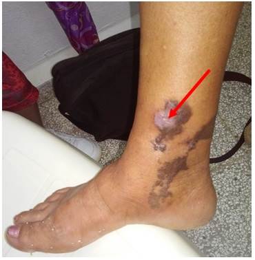 Placas eritematomarronáceas, papuloescamocostrosas, en la extremidad inferior derecha, de tamaño variable, con bordes irregulares, festoneados y límite neto. La flecha señala la lesión fibrótica sobre una de las placas, en relación con ulceración 2 meses atrás (vista lateral interna).