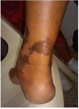 Placas eritematomarronáceas, papuloescamocostrosas, en la extremidad inferior derecha, de tamaño variable, con bordes irregulares, festoneados y límite neto (vista posterior).