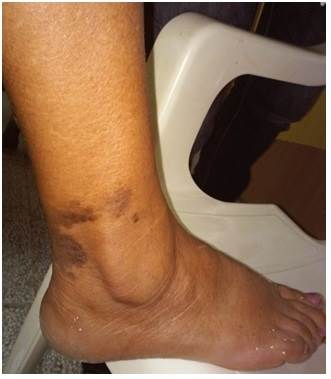 Placas eritematomarronáceas, papuloescamocostrosas, en la extremidad inferior derecha, de tamaño variable, con bordes irregulares, festoneados y límite neto (vista lateral externa).