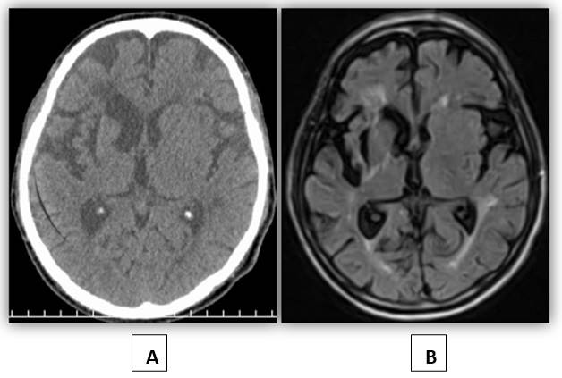 Correlación por TAC (A) y RMN (B) de lesión periventricular derecha en relación con HIP antiguo. Daño difuso de sustancia blanca y severa atrofia