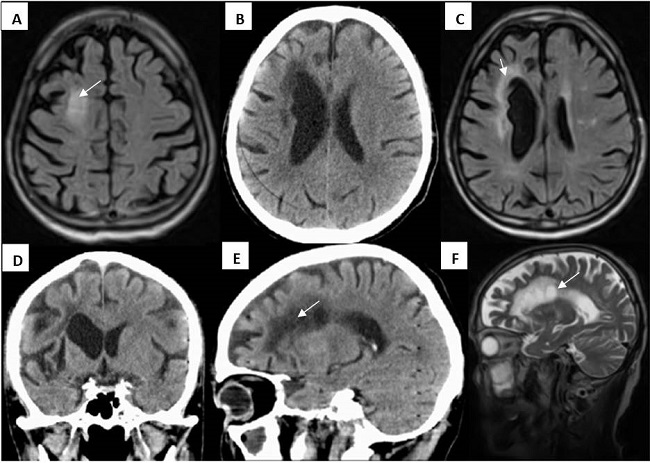 Afectación supratentorial multifocal con lesiones del cuerpo calloso que irradian en forma de dedos de Dawson.