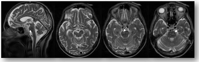 Afectación infratentorial con lesión mesencefálica derecha y bilaterales puntiformes diseminados en protuberancia.RM de médula espinal normal.