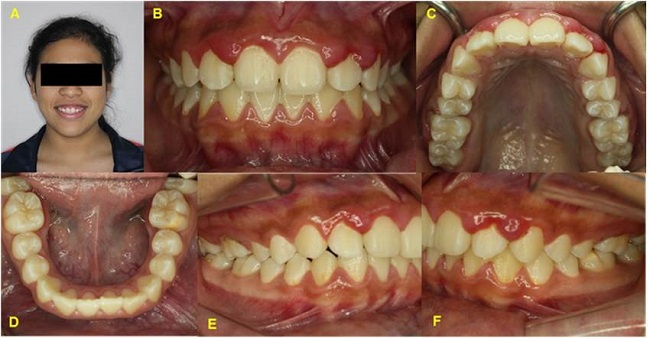 Vistas del caso presentado A. Vista extraoral de la sonrisa gingival. B. Vista frontal que evidencia el agrandamiento anterosuperior. C. Vista oclusal superior sin inflamaci&oacute;n palatina. D. Vista oclusal inferior sin inflamaci&oacute;n. E. Vista lateral derecha con ac&uacute;mulo de biofilm calcificado. F. Vista lateral izquierda con inflamaci&oacute;n localizada.