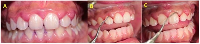 Tratamiento mec&aacute;nico del caso A. IHO (&iacute;ndice de higiene oral) luego de la fisioterapia B. Raspaje con raspador Jacquette 30/33 C. Alisado dentario con curetas Gracey (3/4, 5/6).
