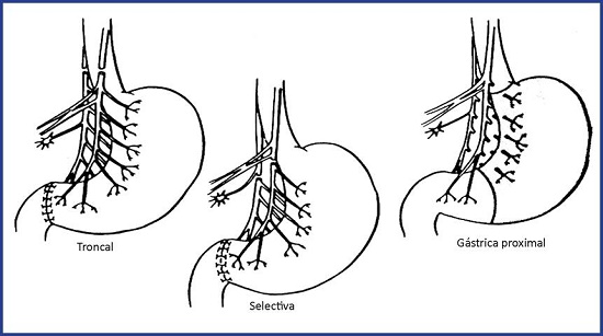 Los tres tipos de vagotomía más comúnmente descritos: Vagotomía troncal, Vagotomía selectiva y Vagotomía Gástrica proximal o altamente selectiva.10