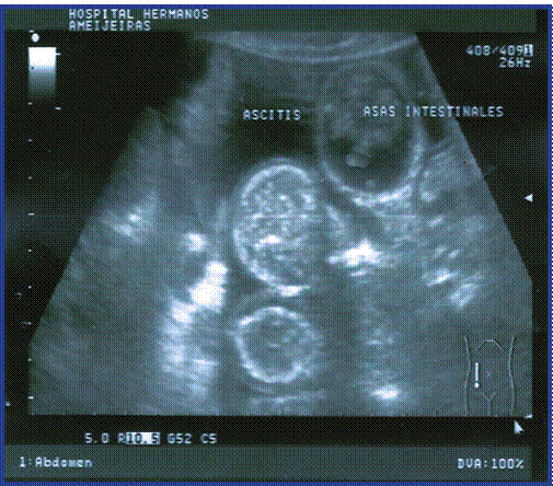 Ultrasonido de Abdomen