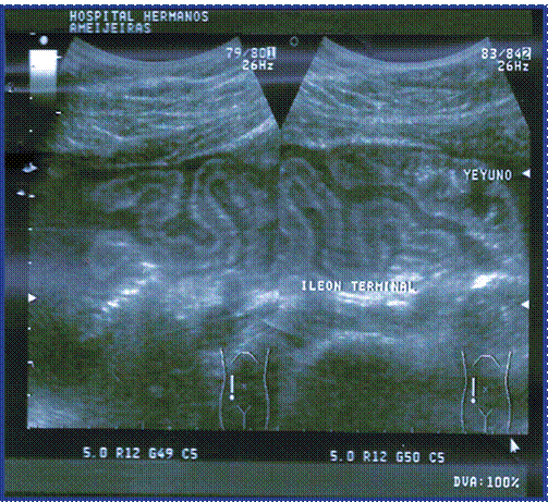 Ultrasonido de Abdomen