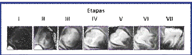 Esquema de formaci&oacute;n y desarrollo para los terceros molares