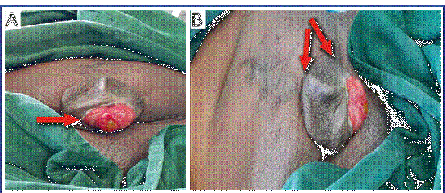 Vistas AP y lateral del abdomen. Cicatriz media infraumbical y asa intestinal expuesta con salida de contenido intestinal