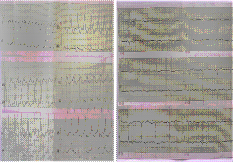 1A- Trazado electrocardiogr�fico de 12 derivaciones con taquicardia ventricular monom�rfica sostenida. 1B-Electrocardiograma en ritmo sinusal poscardioversi�n el�ctrica.