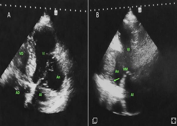 2A- Vista apical de 4 c�maras ampliada que muestra aneurisma en pared anterolateral. 2B- Vista apical de 2 c�maras que muestra el aneurisma en pared inferior medio basal con trombo en su interior (se�alado con la flecha). AD: Aur�cula derecha, An: Aneurisma, AI: Aur�cula izquierda, VD: Ventr�culo derecho, VI: Ventr�culo izquierdo, VM: V�lvula mitral