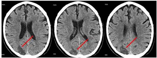 TAC de cr�neo (a las 48 h de evoluci�n) muestra �rea de infarto isqu�mico reciente en el territorio de la ACP derecha.