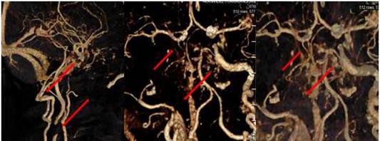 Angio-TC de cr�neo evidencia la presencia de oclusi�n completa de la arteria car�tida interna derecha en su origen, con demostraci�n de flujo de contraste a nivel de la arteria car�tida interna en regiones petrosa, cavernosa y ACM, y una ACP derecha que nace directamente de la car�tida supraclinoidea (ACP fetal), la misma se encuentra ocluida en su tercio distal.