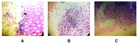 Histolog�a panor�mica; B:Microfotograf�a tumoral; C:Histolog�a a campo aumentado.