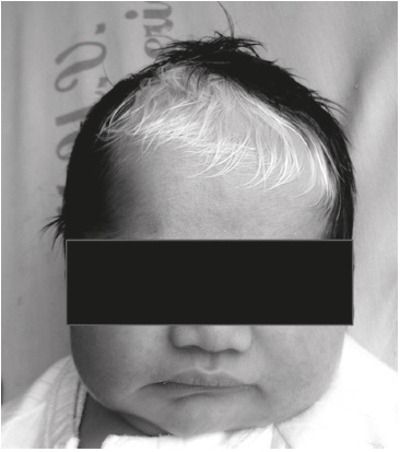 Poliosis y desviación de la comisura labial hacia la derecha