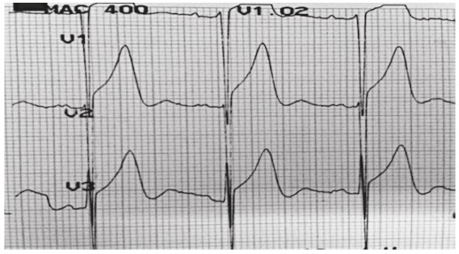 Cambios electrocardiogr&aacute;ficos en las derivaciones V1-V3