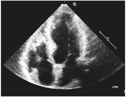 Ecocardiograf&iacute;a. Se observa hipertrofia ventricular izquierda sin dilataci&oacute;n de cavidades