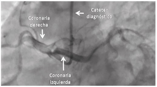 Arteriograf&iacute;a coronaria. Se observan el nacimiento an&oacute;malo del tronco de la arteria coronaria izquierda y la derecha sin lesiones
