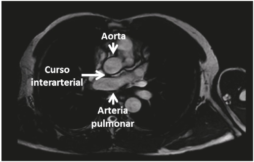 Resonancia magn&eacute;tica card&iacute;aca. Se observa el origen an&oacute;malo de la coronaria izquierda en el seno derecho con trayecto interarterial, entre la aorta y la arteria pulmonar