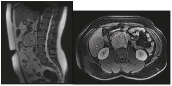 Resonancia magnética abdominal. Masa muy vascularizada de contornos bien definidos, anterior a la aorta abdominal y a la vena cava inferior, y que desplaza la tercera y cuarta porciones del duodeno.