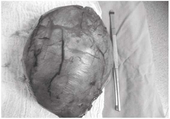 Espécimen quirúrgico. Lesión nodular elástica que pesa 102 gramos y mide 6,5 x 6 x 4,3 cm; la superficie es parda, intensamente congestiva y con tejido fibroadiposo adherido