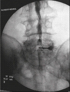 Espacio L5-S1. Inyecci&oacute;n del contraste con patr&oacute;n subdural